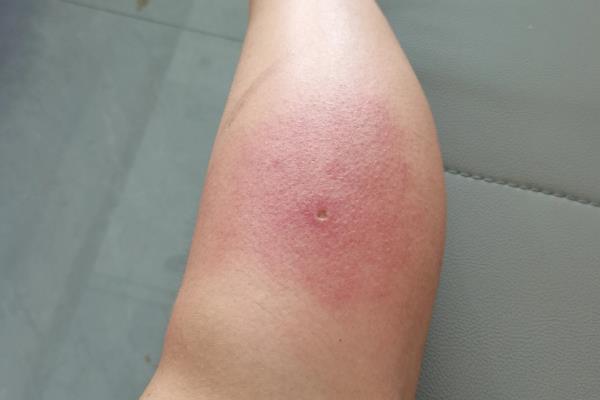 马蜂蛰了如何消肿，及时将毒针用镊子拔出来