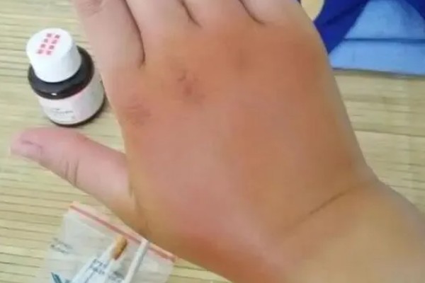 被马蜂蛰了怎么办,及时拔掉毒针