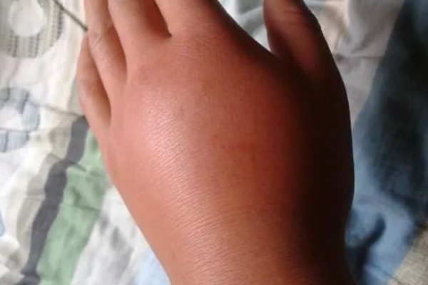 被马蜂蛰了怎么办,及时拔掉毒针