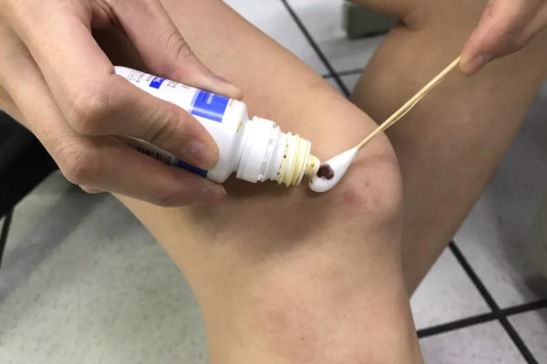 被蜜蜂蜇了如何处理，需及时取出毒针
