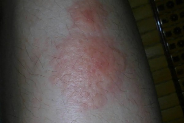 被隐翅虫咬后擦什么药,可以擦地奈德乳膏等