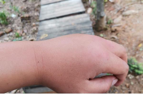 被蜜蜂蛰了是不是鸿运当头的征兆,属于迷信说法被蛰后应尽快处理