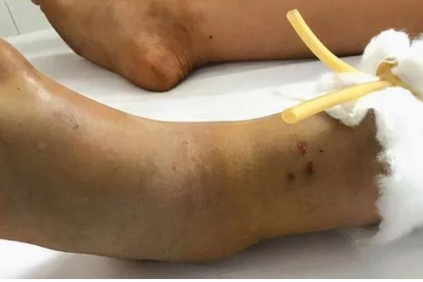 五步蛇的名称由来,有以下3种解释