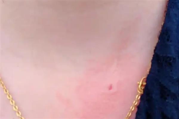 被黑尾虎头蜂蛰了怎样处理，需及时将毒针拔出