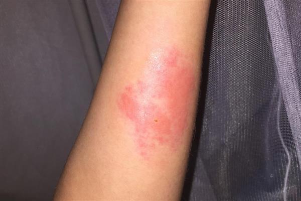 被黑尾虎头蜂蛰了怎样处理，需及时将毒针拔出