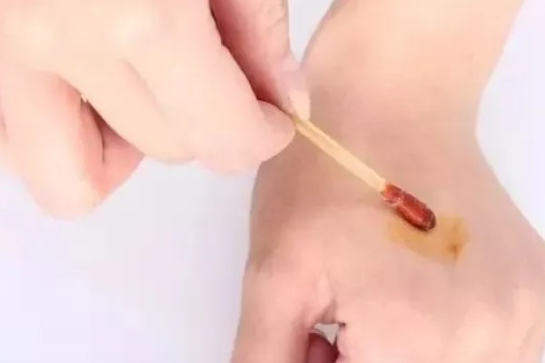 被马蜂蛰了如何处理,涂抹云南白药可快速消肿止痛