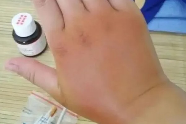 被马蜂蛰了如何处理,涂抹云南白药可快速消肿止痛