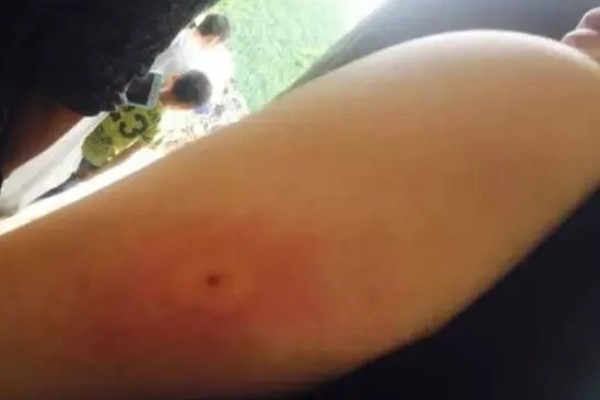被马蜂蛰了如何处理,涂抹云南白药可快速消肿止痛